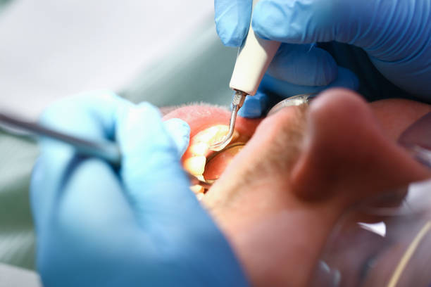 Best Emergency Wisdom Teeth Removal in New Carlisle, OH