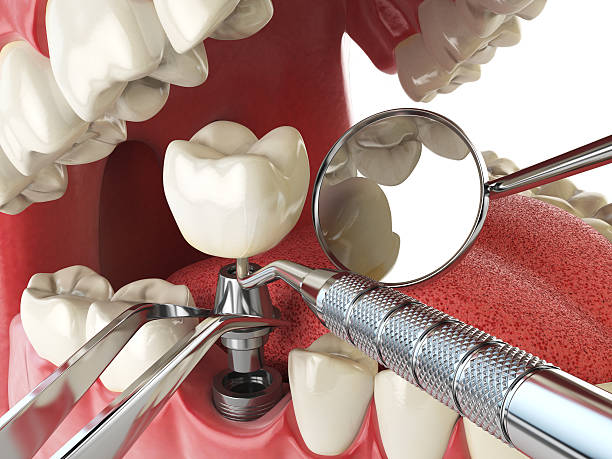 Best Emergency Dental Care for Broken or Chipped Teeth in New Carlisle, OH